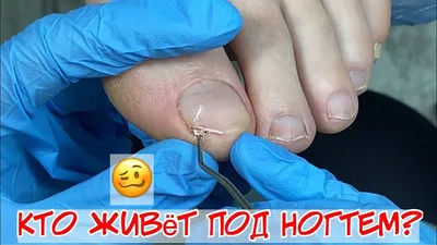 how take away subungual corn on leg 😱 Why hurt fingernails on legs?  🥴Smart pedicure fingers - YouTube