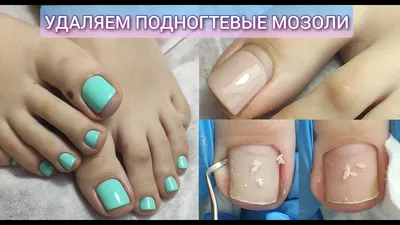 ОГРОМНЫЕ ПОДНОГТЕВЫЕ МОЗОЛИ😱Как убрать подногтевую мозоль подробно😑Почему  болят ногти на ногах? 腳趾甲 - YouTube