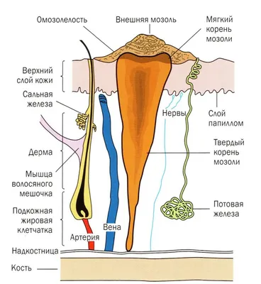 Galyna Podo-nails - Корневая или стержневая мозоль — самый сложный для  лечения вид мозоли. Стержневая мозоль имеет стержень (корень), который  располагается глубоко в коже и может даже проникать в мягкие ткани. Это