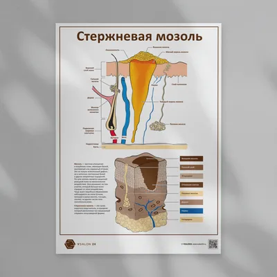 Стержневая мозоль – это разновидность сухой мозоли, которая имеет корень  или стержень. ⠀ Самыми частыми причинами возникновения стрежневой… |  Instagram