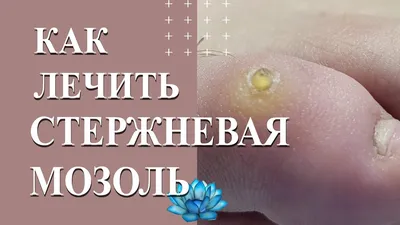 ⭕️СТЕРЖНЕВЫЕ МОЗОЛИ⭕️ Что это такое ❓ Стержневая мозоль – это сухая мозоль,  у которой есть плотный корень (стержень), уходящий глубоко… | Instagram