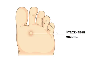 Стержневые мозоли: что такое, профилактика и способы лечения!