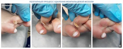 Да да это стержневой мозоль. Который... - likarpenkava_nails | Facebook