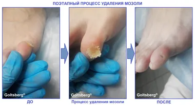 Remove the callus. Deep callus. Pedicure. Removing corns on the legs. DEEP  INVENTION - YouTube