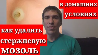 Как избавиться от мозолей в домашних условиях: действенные способы