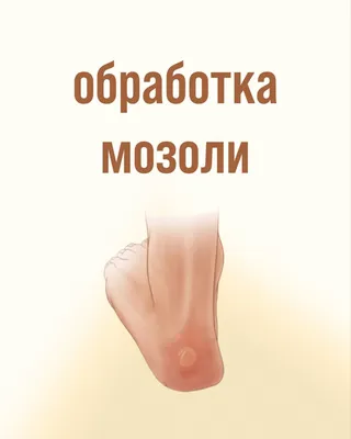 Сезон босоножек: как избавиться от мозолей и натоптышей - новости медицины