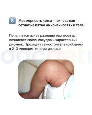 Рыхлая мраморная кожа 3,5 месяца малышу — 8 ответов | форум Babyblog