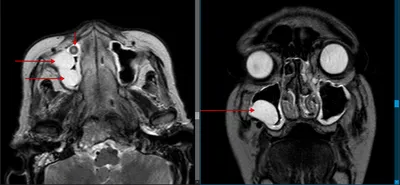 МРТ пазух носа - цена приема в Жулебино, Люберцах, Котельниках