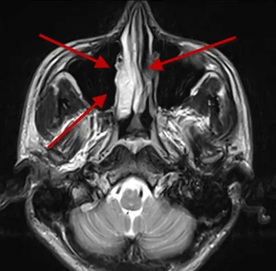 МРТ ПАЗУХ НОСА. РАЗБОР КЛИНИЧЕСКОГО СЛУЧАЯ. | D2D Expert | Дзен