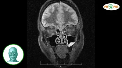 МРТ околоносовых пазух всего от 2 500 рублей