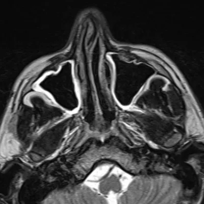 МРТ пазух носа в Москве выгодная цена