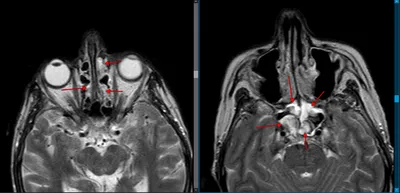 МРТ или КТ пазух носа - что лучше, разница и отличия томография