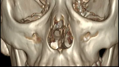 Неврологический Центр \"Кортекс\" - Магнитно резонансная томография пазух носа  позволяет безошибочно выявлять воспалительные процессы, опухолевые и другие  заболевания. ⠀ Запущенные случаи в этой области могут привести как к потере  обоняния, так и