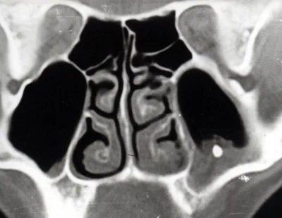 Вопросы и ответы специалистов - КТ носовых пазух