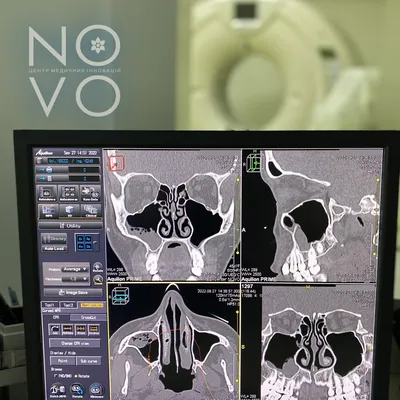 КТ пазух носа, Севастополь | КлиникЛабДиагностика