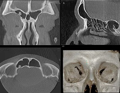 МРТ челюстно-лицевой области, околоносовых пазух | МЕДИКОМ