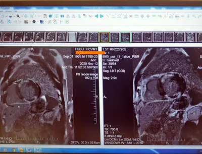 Магнитно-резонансная томография (МРТ) грудной клетки