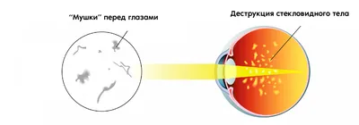 Офтальмика - «Мушки» перед глазами. Что это? И как от них избавиться? «Мушки»  перед глазами могут появляться по разным причинам и, как правило, вызваны  скоплением в стекловидном теле глаза измененных частиц. Такие \"