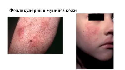 Муцинозы кожи. Склеромикседема Арндта—Готтрона