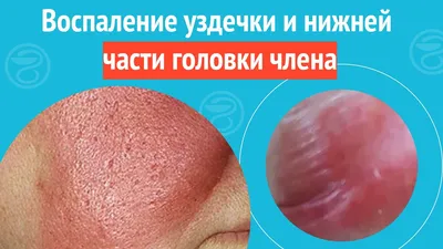 Uromed Clinic - Уздечка мужского полового члена располагается на задней  поверхности органа, соединяя крайнюю плоть с головкой. Уздечка представляет  собой своеобразный тяж, соединительную ткань, складку кожи, расположенную  продольно. Крайняя плоть ...