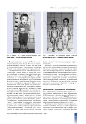 Синдром мышечной дистонии - Официальный сайт ФНКЦ детей и подростков ФМБА  России