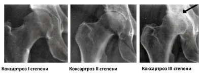 Лечение Повреждение суставной губы - Ортопедия Руслана Сергиенко