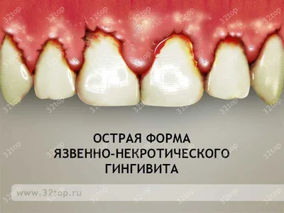 Дентал Фэнтези - Помните, как в нашем детстве проходило лечение пульпита?  Или мышьяк или жутко болезненное извлечение нерва из зуба! Кабинет  стоматолога после этого многие потом ещё долго обходили стороной)) Отсюда и