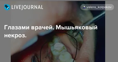 Как убить нерв в зубе: как выглядит, где находится и как можно убить зубной  нерв в домашних условиях?