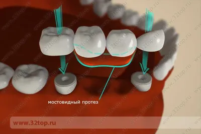 Мышьяк в зубе: зачем кладут и сколько нужно с ним ходить | Wday.ru | Дзен