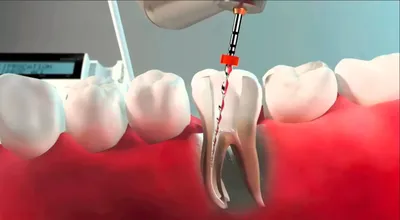 Больно ли удалять зубной нерв с уколом