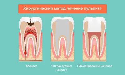 Выпадает пломба из зуба – что делать?. Статьи «ДОКТОР ДЕНТ».