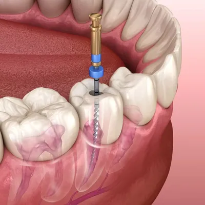 Пульпит зуба: лечение, симптомы, цены на лечение каналов в стоматологии —  ROOTT