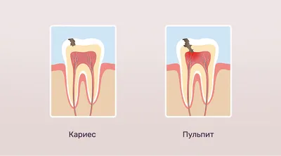 Медикаментозный периодонтит - причины, симптомы, диагностика, лечение