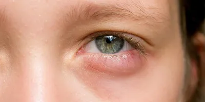 Аллергический конъюнктивит: причины, симптомы, диагностика, лечение