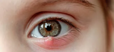 Аллергический конъюнктивит глаз: лечение, симптомы, причины возникновения у  взрослых