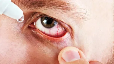 Блефарит глаз — причины, симптомы и лечение в MAJOR CLINIC