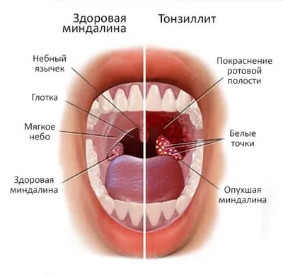 Тонзиллит - причины появления, симптомы заболевания, диагностика и способы  лечения