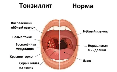 Почему болит горло с одной стороны | Новости Аркада-Мед