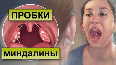 Боль в горле и белые точки на миндалинах - Вопрос лору - 03 Онлайн