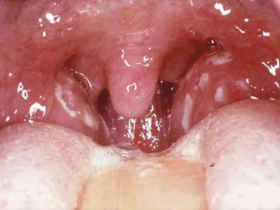 Острый тонзиллит — Рувики: Интернет-энциклопедия