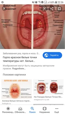 Во рту появилась белая язвочка: как лечить