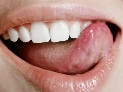 Рак полости рта: симптомы, признаки, лечение, прогноз