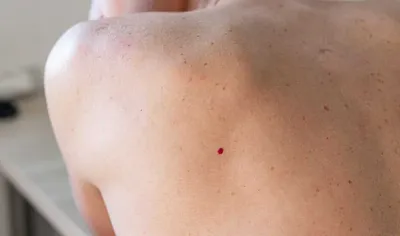Красные точки на коже: причины, симптомы и методы лечения
