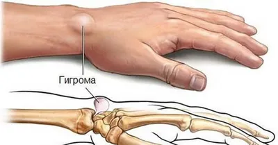 Шишка на руке - фото и картинки: 66 штук