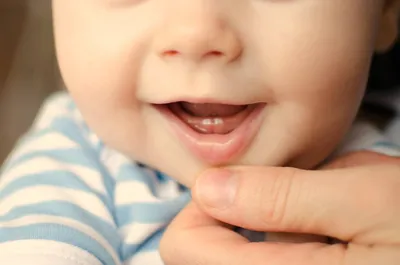 Как выглядят десны перед зубами? — 12 ответов | форум Babyblog