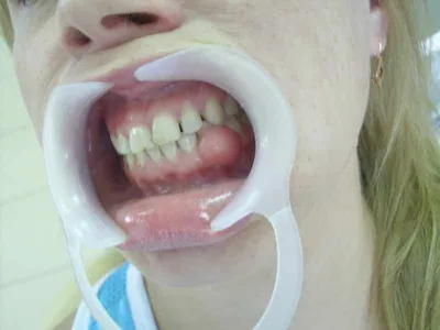 Опухоли десен - лечение в стоматологии в Санкт-Петербурге | Клиника 32