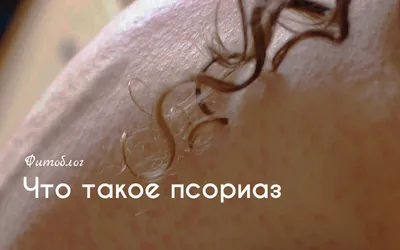 Лечение псориаза на голове в клинике в Москве | Без гормональных  препаратов, ремиссия до 5-6 лет