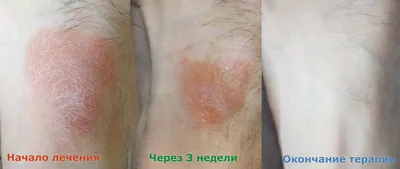 Грибок ногтей: симптомы и лечение - Клиника ТРИНИТИ (Москва)