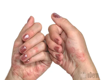 Лечение гомеопатией псориаза кожи у мужчин и женщин - Клиника С Ганемана