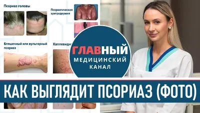 Лечение псориаза в Киеве Лечение псориаза стволовыми клетками Good Cells